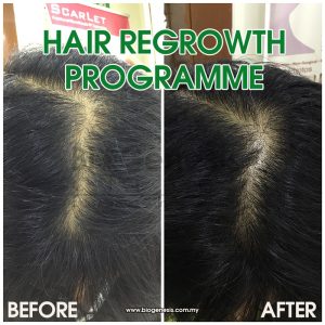 Hair Regrowth - Before After