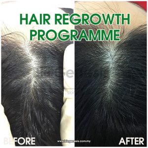 Hair Regrowth - Before After