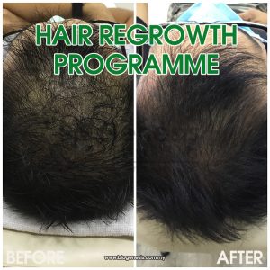 Hair Regrowth - Before After