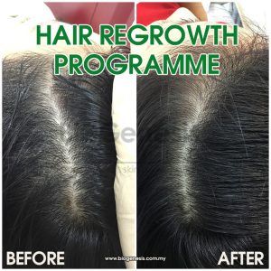 Hair Regrowth - Before After